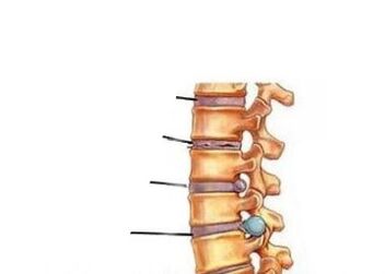 Štyri štádiá vývoja osteochondrózy